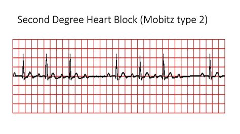 Study Medical Photos: ECG Findings In Different Types Of Heart Block.