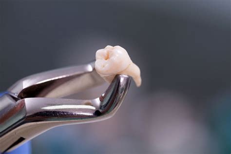 What to Expect After Wisdom Tooth Extraction | Arrowhead Dental