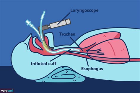 Intubation: Purpose, Risks, and Recovery