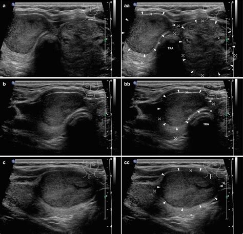 Thyroid Goiter Ultrasound