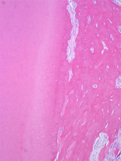 Cementoblastoma Histology