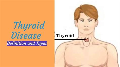 Thyroid Disease: Definition And 3 Types » 2022