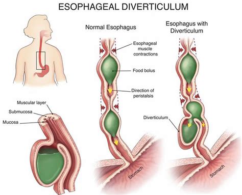 Esophageal diverticulum causes, types, symptoms, diagnosis & treatment