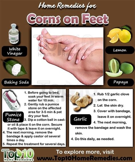 Home Remedies for Corns on Feet - Page 2 of 3 | Top 10 Home Remedies