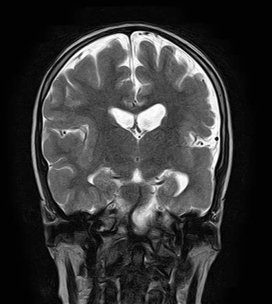 Lissencephaly Mri