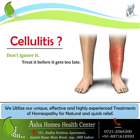 Cellulitis Treatment