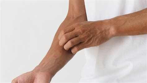 3 Most Common Treatments for Shingles - North Lakes Pain Consultants