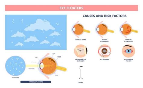 Eye Floaters: Causes & How to Get Rid of Them for Good | NVISION