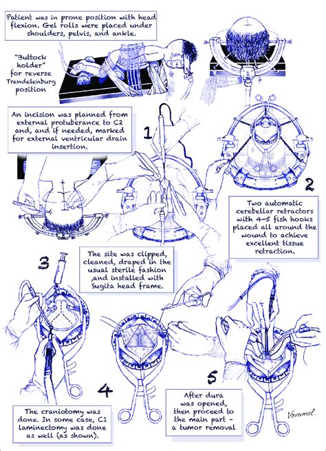 Posterior fossa craniotomy. | Download Scientific Diagram