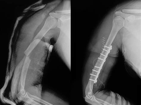 Dr Terence Moopanar | Shoulder fracture management