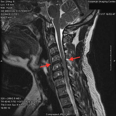 Cureus | A Novel 3D Printed Titanium Implant for Anterior Cervical ...