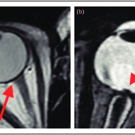 (a) Axial T1-weighted MRI shows normal appearance of the optic nerve ...