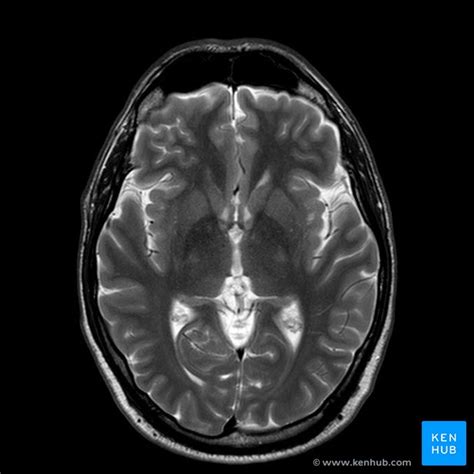 Brain MRI: How to read MRI brain scan | Kenhub