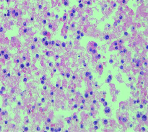 Cytological examination of the pleural fluid showing numerous atypical ...