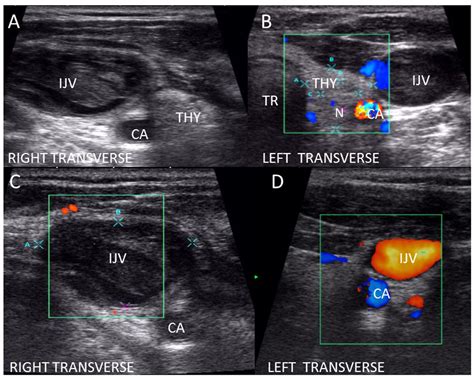 Normal Thyroid Ultrasound