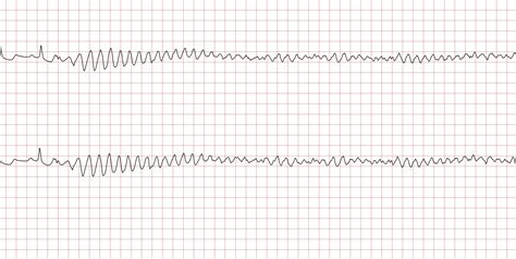 Sudden cardiac arrest: Case 2 – Cardiovascular Education