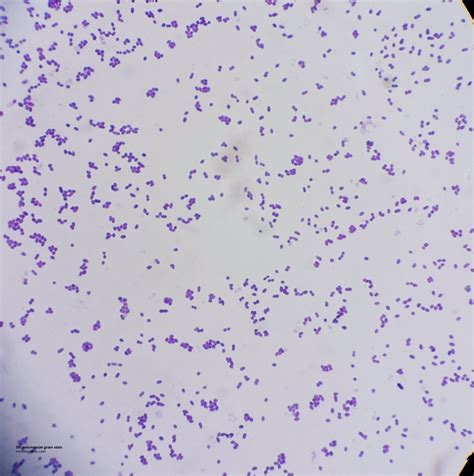 Streptococcus pneumoniae (Pneumococcus) | Pneumococcus, Streptococcus ...