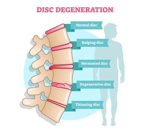 The 3 Stages Of Degenerative Disc Disease | New Jersey | Comprehensive ...