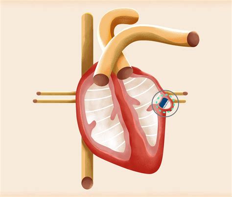 Watchman Procedure for Atrial Fibrillation - FixAFib