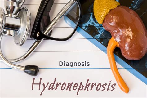 Understanding Hydronephrosis: Causes, Symptoms, and Treatment - Facty ...