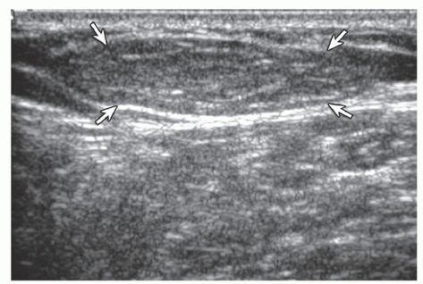 Lipoma. Ultrasound image shows oval hyperechoic subcutaneous lipoma ...