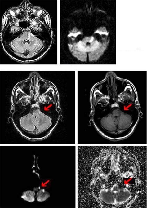 On MRI (top panel), a focal left pontine intra-axial infarct is seen as ...