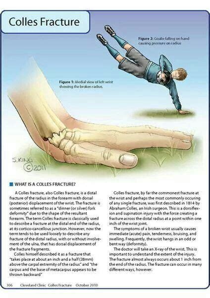 Colle's Fracture Info | Medical knowledge, Medical anatomy, Medical facts