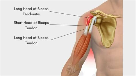 Biceps Tendon