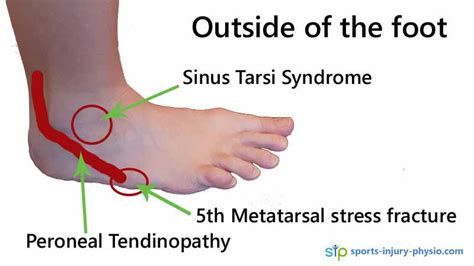 Foot pain in runners - A quick guide | Sports Injury Physio