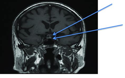 Pituitary Anatomy Mri