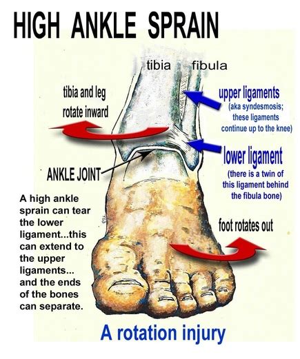 High Ankle Sprain - Dr. Allison Reid, Chiropractor