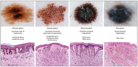 The 4 main dermoscopic morphologic structures of nevi correspond to ...