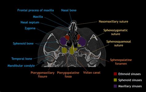 Cranial Bone Anatomy Ct Axial