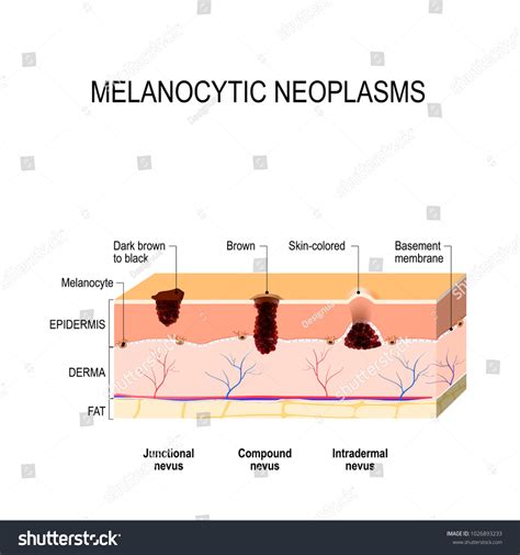 Melanocytic Nevus Junctional Compound Intradermal Nevus 库存插图 1026893233 ...