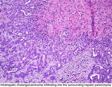 Pathology Outlines - Intrahepatic cholangiocarcinoma (small and large ...