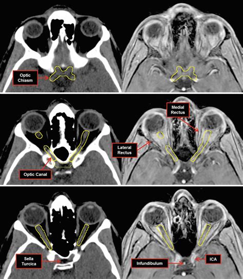 Nerves | Radiology Key