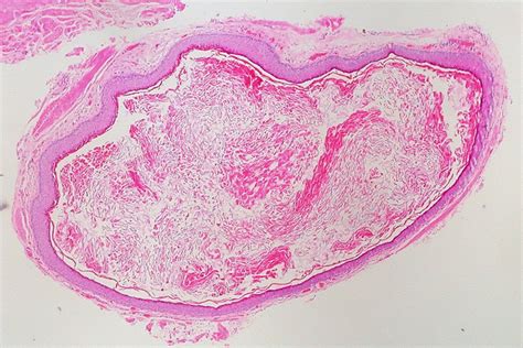 Epidermal Inclusion Cyst