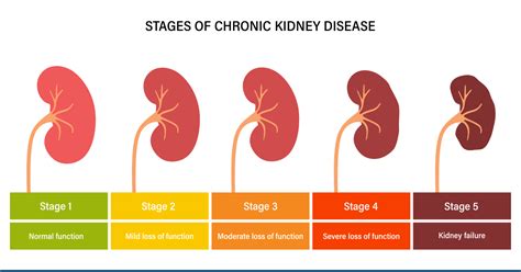 What Are The 5 Stages Of Chronic Kidney Disease?