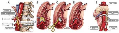 Cureus | Two Decades of Experience With Chronic Mesenteric Ischaemia ...