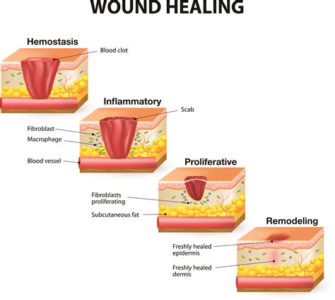 How Wounds Heal: The 4 Main Phases of Wound Healing | Shield HealthCare