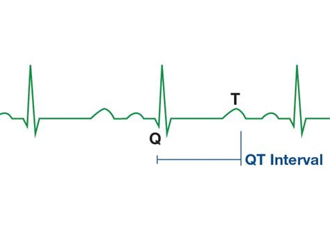 Long QT syndrome - Symptoms and causes - Mayo Clinic