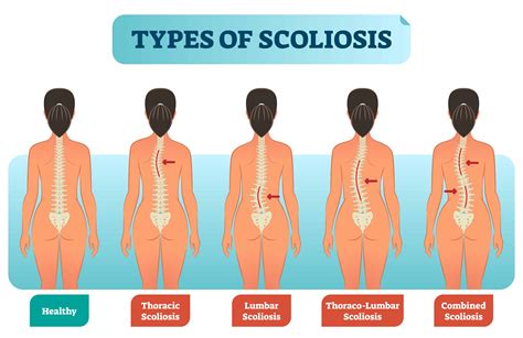 How to Sleep With Scoliosis (Helpful Tips Included) - Lully Sleep