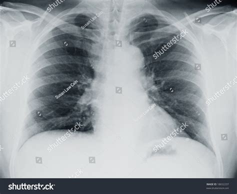 Lung Xray Showing Congestion Lungs Stock Photo 18652237 | Shutterstock