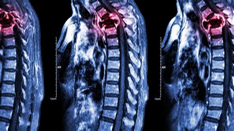 Does Thyroid Cancer Metastasis To The Brain