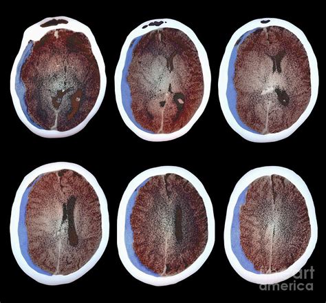 Brain Haemorrhage, Ct Scans Photograph by Zephyr