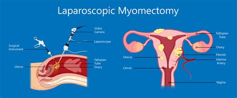 Myomectomy Surgery Melbourne » Fibroids Removal — A/Prof Alex Ades