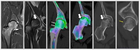 Medicina | Free Full-Text | Reviewing Bone Marrow Edema in Athletes: A ...