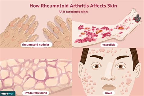 What Skin Problems Does Rheumatoid Arthritis Cause?