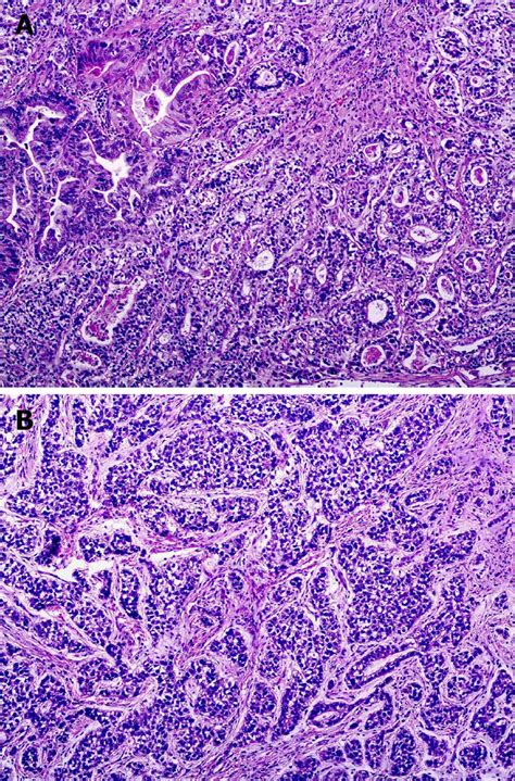 Cholangiocarcinoma Histology