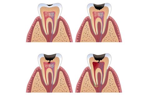 How to Avoid Tooth Nerve Damage | Directorio Odontológico